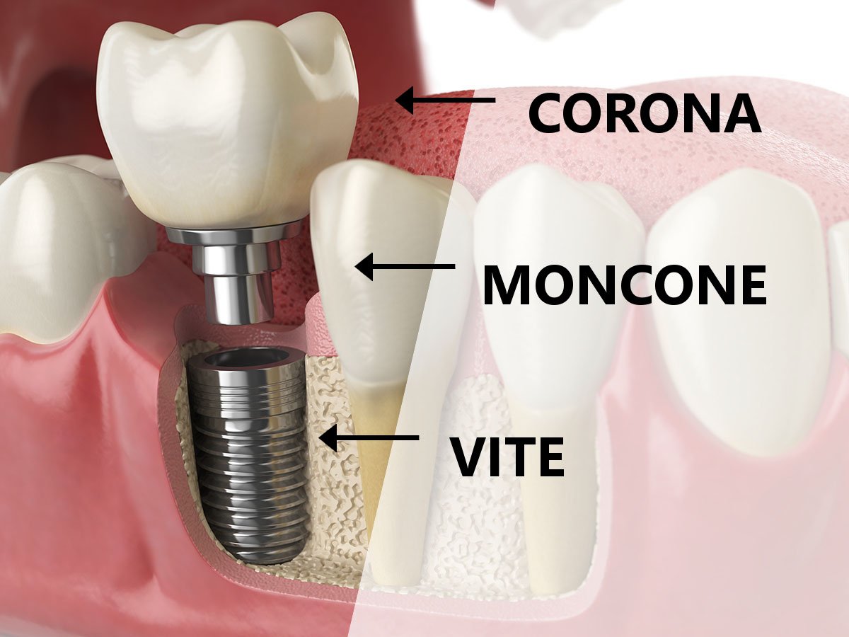 com'è fatto un impianto dentale a roma