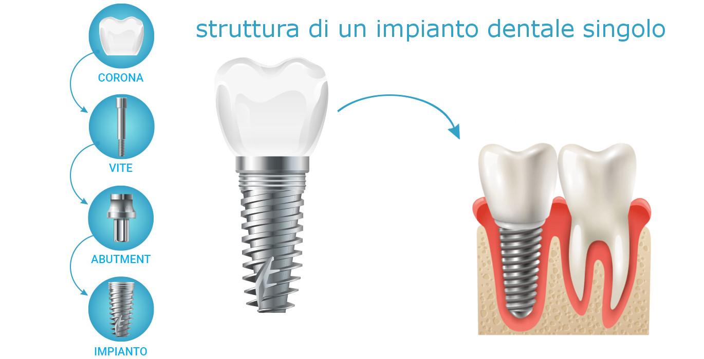 impianto dentale a roma